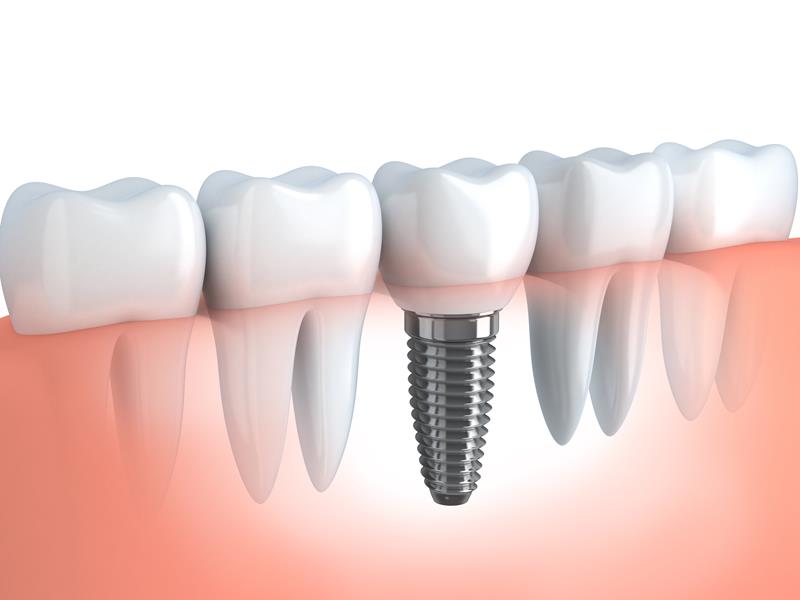 Dental Implants  Safety Harbor, FL 